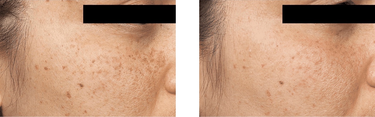 BEFORE & One month AFTER six treatments with Clear + Brilliant