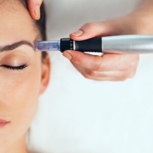 microneedling